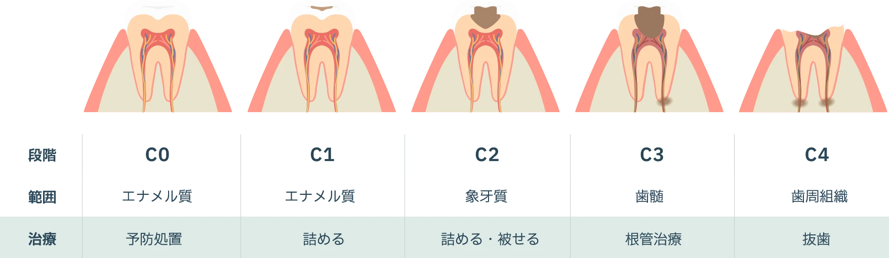 虫歯の進行ステージ